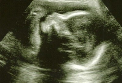 26 Week Sonogram